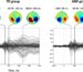 MEG ile ölçülen işitsel beyin yanıtlarının TD (tipik gelişim) ve otizmde iştisel işlemleme bakılan grupları arasında karşılaştırıldığı grafik. M50, M100 ve M200 yanıtlarının zamana göre değişimi ve beyin aktivite haritaları gösteriliyor.