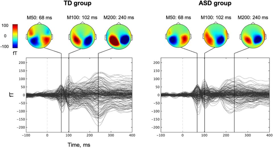 MEG ile ölçülen işitsel beyin yanıtlarının TD (tipik gelişim) ve otizmde iştisel işlemleme bakılan grupları arasında karşılaştırıldığı grafik. M50, M100 ve M200 yanıtlarının zamana göre değişimi ve beyin aktivite haritaları gösteriliyor.